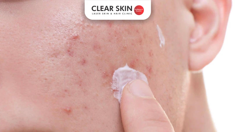 Does scar removal cream work on acne scars?