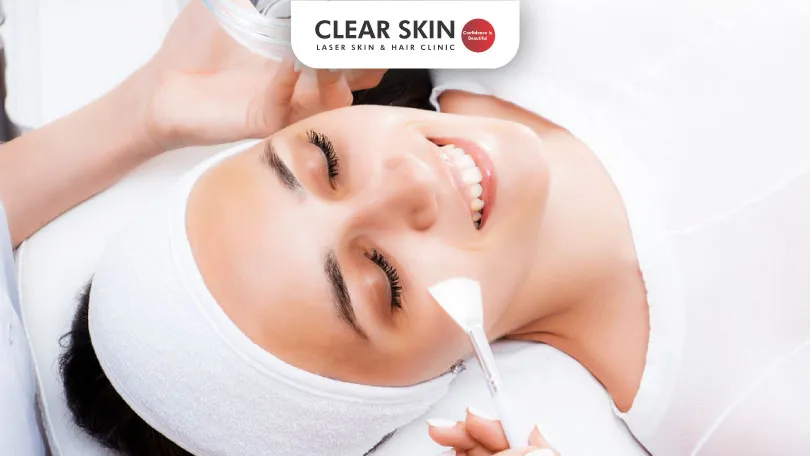 Everything-You-Need-to-Know-About-TCA-Peel-for-Melasma-Clear-Skin-Pune TCA PEEL TREATMENT FOR MELASMA