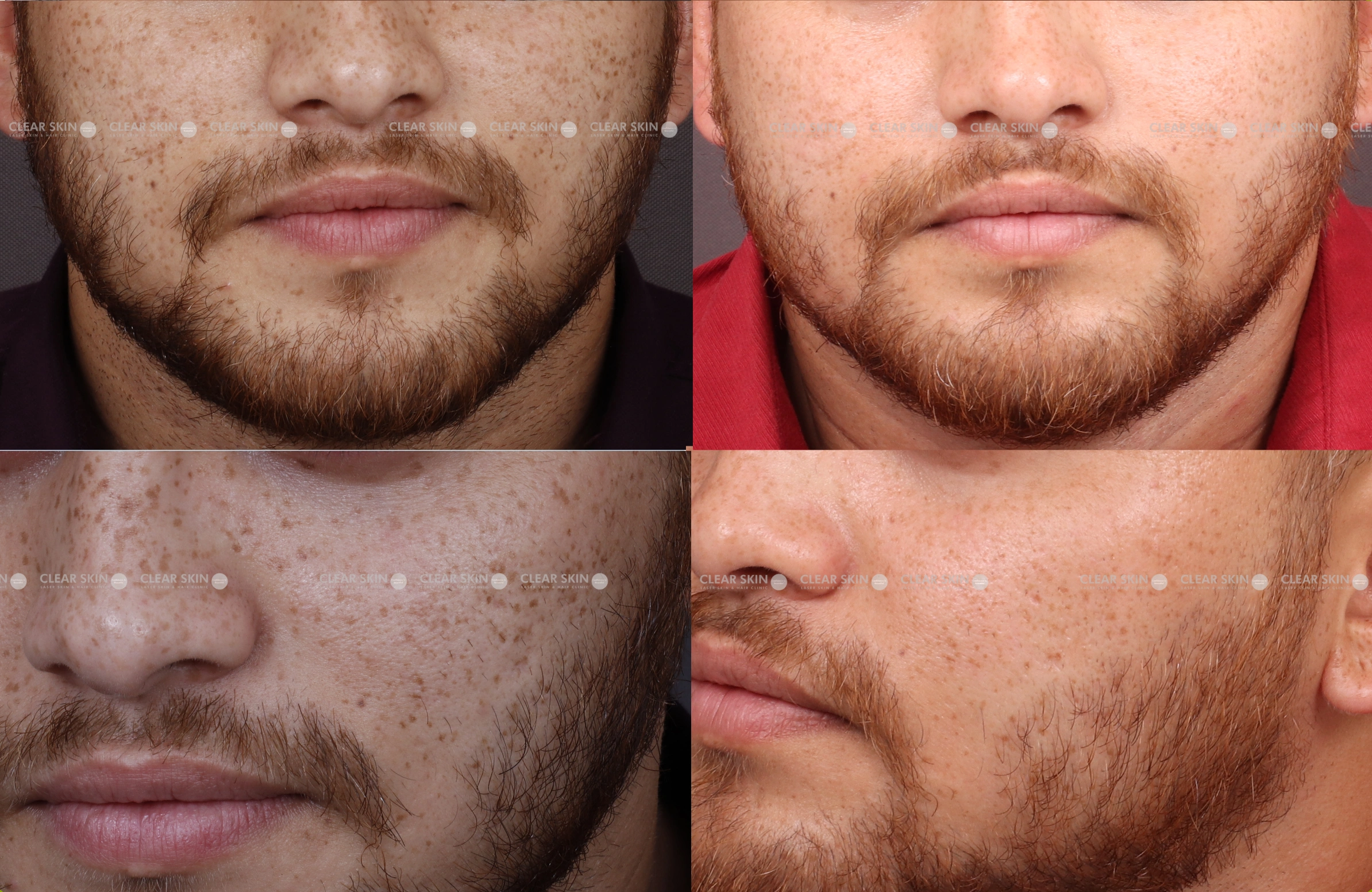 Freckles Results 4 Months Timeline 4 Sessions Clear Skin Pune
