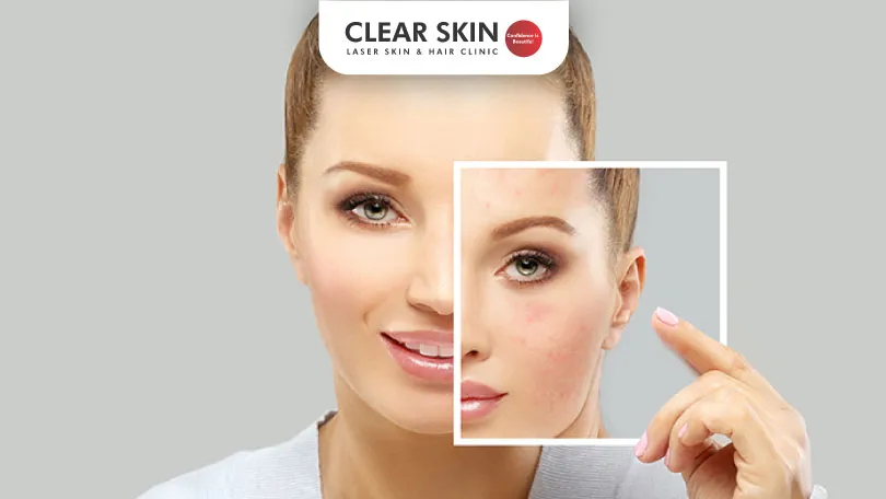 How-Long-Does-it-Take-for-Melasma-to-Go-Away-Clear-Skin-Pune How-Long-Does-it-Take-for-Melasma-to-Go-Away-Clear-Skin-Pune