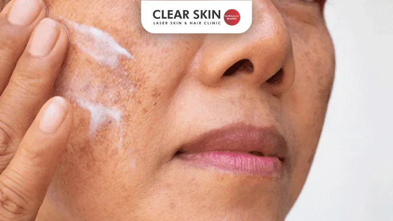 How-Moisturisers-Can-Help-with-Melasma-Prevention-and-Treatment-Clear-Skin-Pune How-Moisturisers-Can-Help-with-Melasma-Prevention-and-Treatment-Clear-Skin-Pune