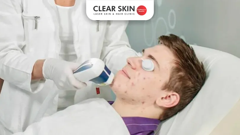 How-Much-Does-Acne-Scar-Treatment-Cost How Much Does Acne Scar Treatment Cost