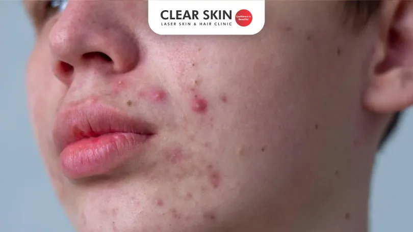 How To Get Rid of Teenage Acne