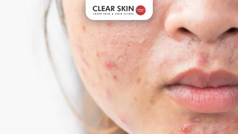 How To Prevent Scarring From Pimples Clear Skin Pune
