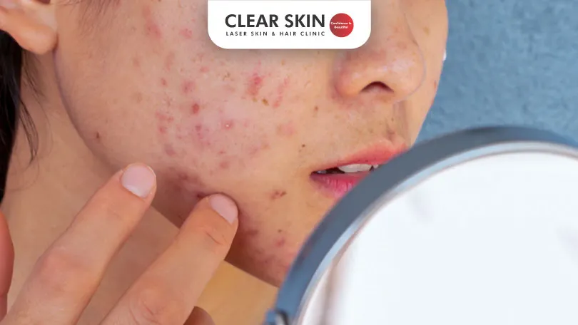 How-To-Take-Care-Of-Acne-Prone-Skin-Clear-Skin-Pune How To Take Care Of Acne Prone Skin Clear Skin Pune