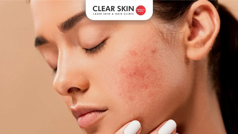 How long did it take for your acne scars to fade