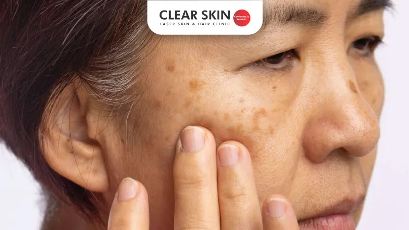 How long does it take for melasma to fade How long does it take for melasma to fade
