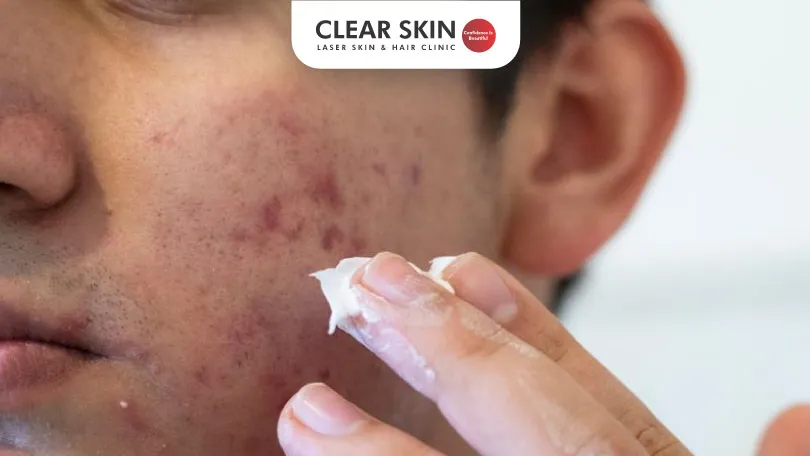 How-to-Get-Rid-of-Acne-Scars-Fast-Clear-Skin-Pune how to get rid of acne marks