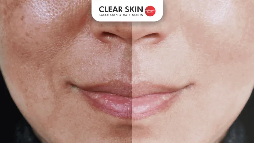 How to cure melasma permanently How to cure melasma permanently?
