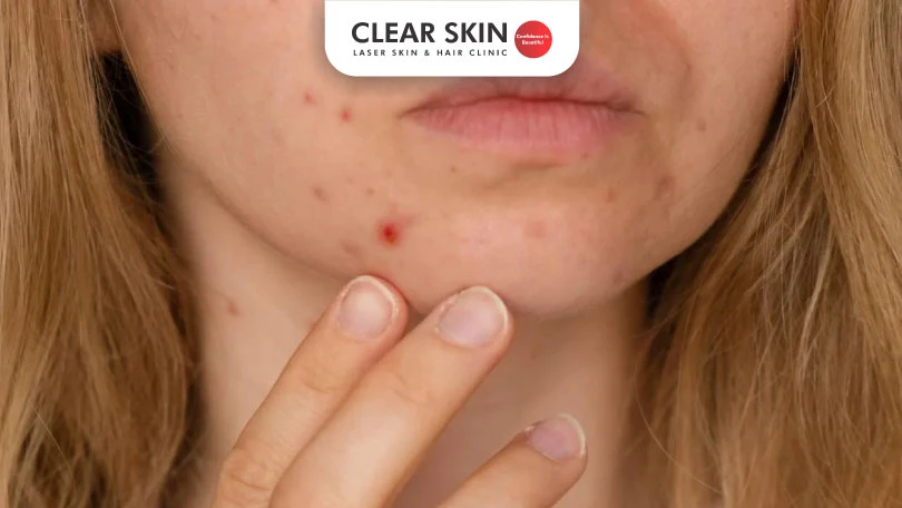 How to get rid of acne dark spots