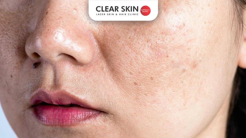How to get rid of acne scars on cheeks and nose