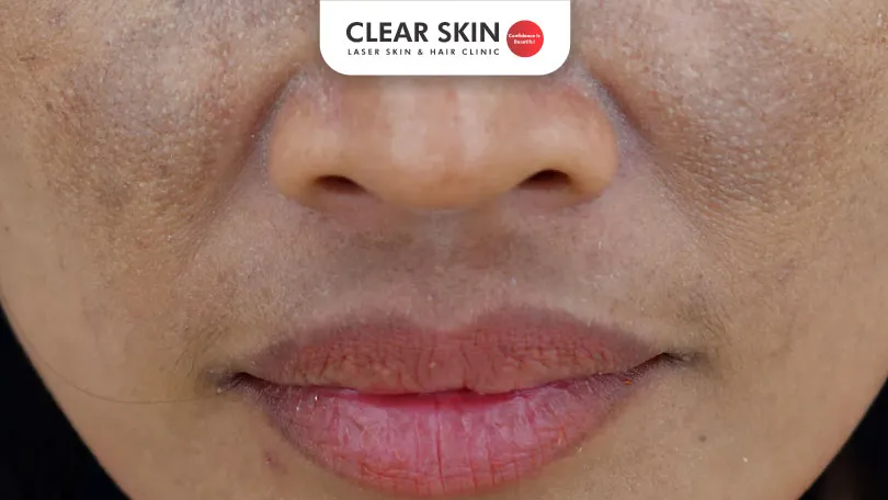 How to get rid of pigmentation around lips