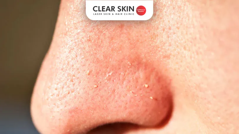 How-to-get-rid-of-whiteheads How to get rid of whiteheads