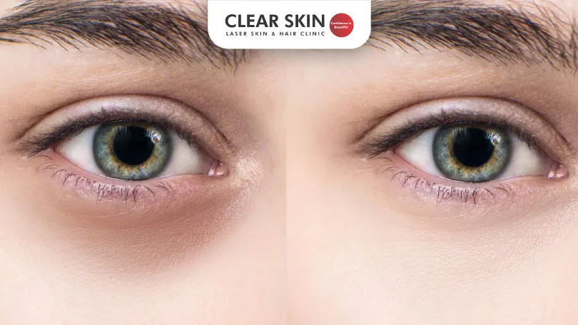How to reduce Dark Circles-Understand the Causes & Treatment