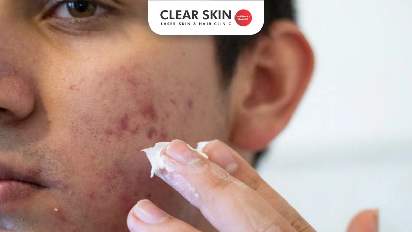How-to-remove-acne-marks How-to-remove-acne-marks