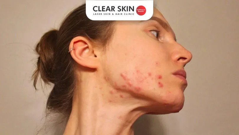 How-to-treat-hormonal-acne How to treat hormonal acne