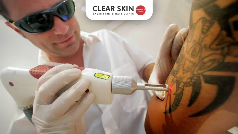 Is Tattoo Removal Painful ? Is Tattoo Removal Painful ?