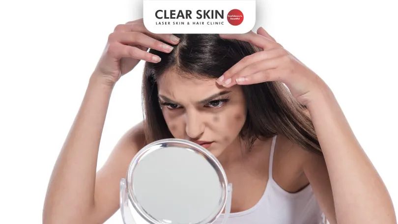 Is there a Connection Between Dandruff and Acne Clear Skin Pune