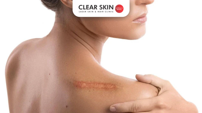 Keloid and Hypertrophic Scar