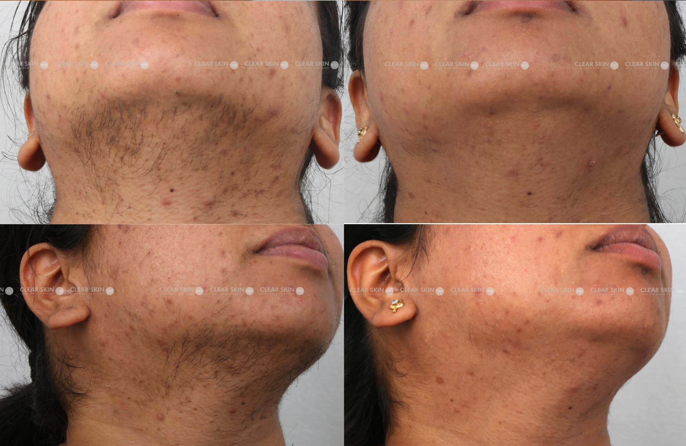 LHR Results 9 Months Timeline 9 Sessions Clear Skin Pune