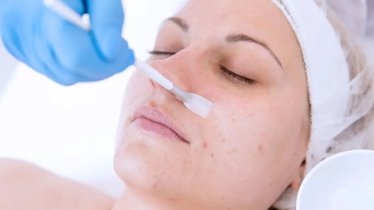 Leave-On-Chemical-Peel-Treatment Leave On Chemical Peel Treatment
