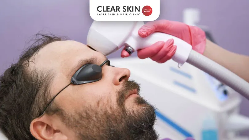 Link Between Laser Hair Removal and Skin Pigmentation Changes Link Between Laser Hair Removal and Skin Pigmentation Changes