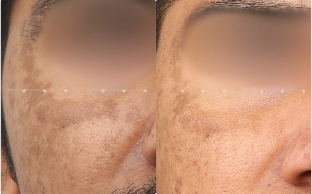 Melasma Results 9 Sessions 10 Months ClearSkin Pune