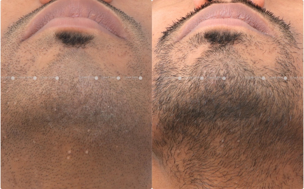 Mollusum Results 2 Sessions 3 Months ClearSkin Pune