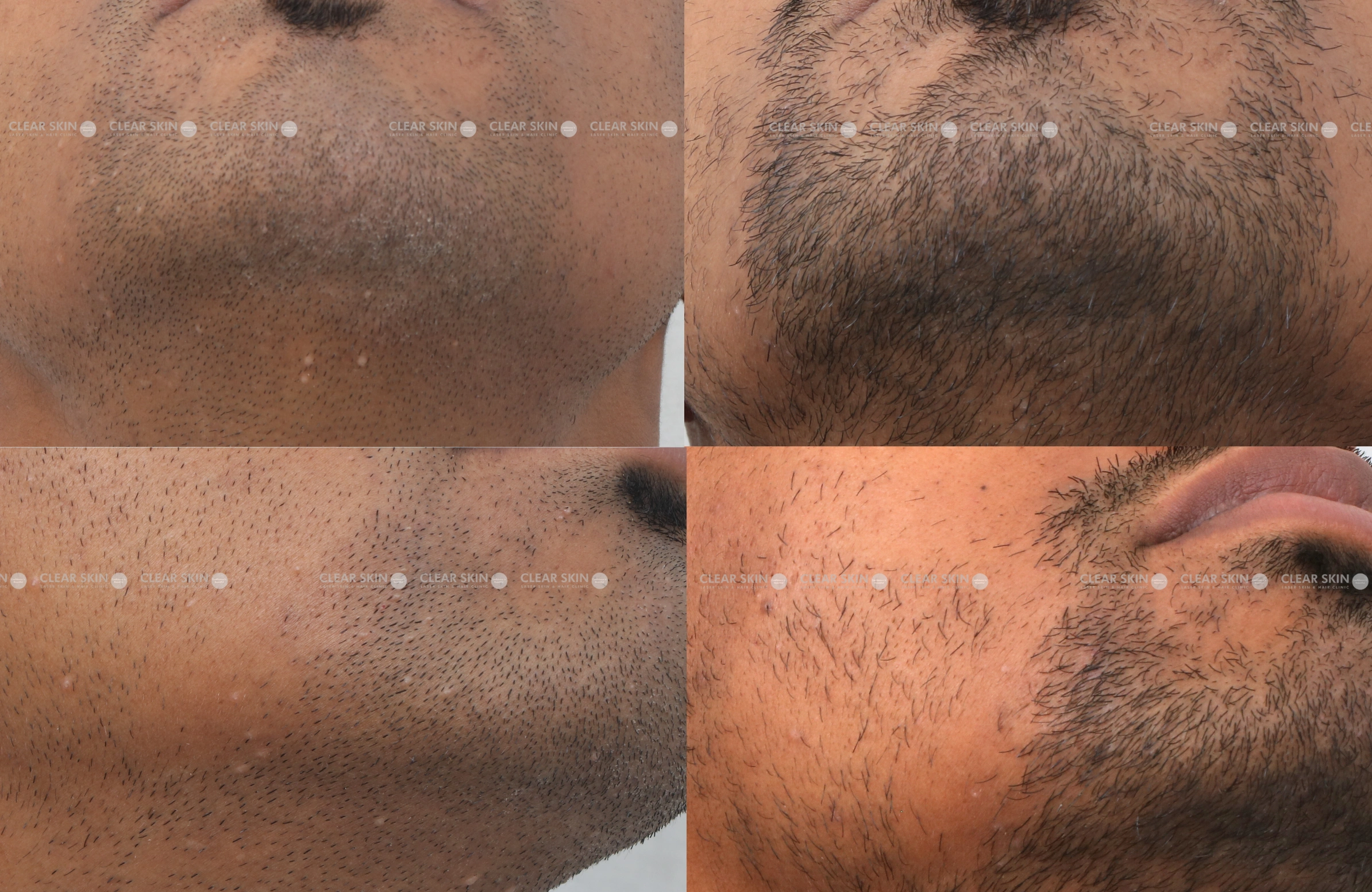 Molluscum Results 3 Months Timeline 2 Sessions Clear Skin Pune