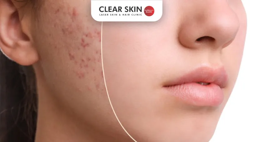 Naturally-Eliminating-Acne-Scars-Expert-Tips-for-Clearer-Skin-clear-skin-pune