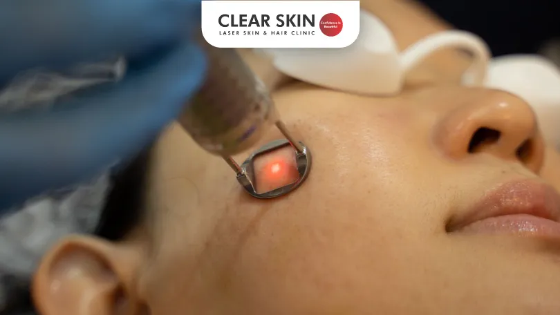 Pico-Laser-Treatment-for-Melasma-Clear-Skin-Pune Pico Laser Treatment for Melasma Clear Skin Pune