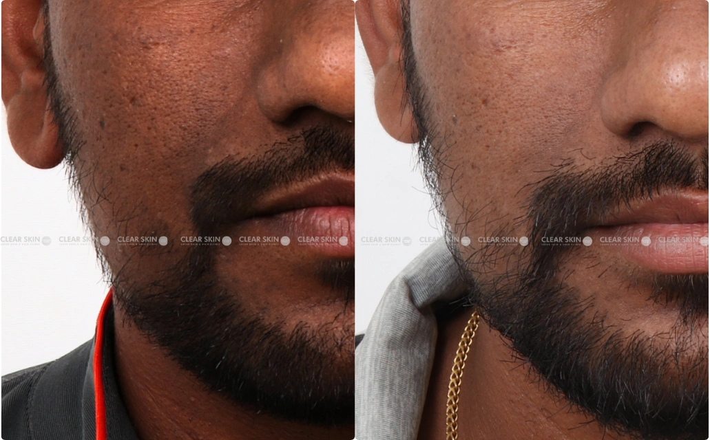 Pigmentation Results 3 Sessions 2 Months ClearSkin Pune