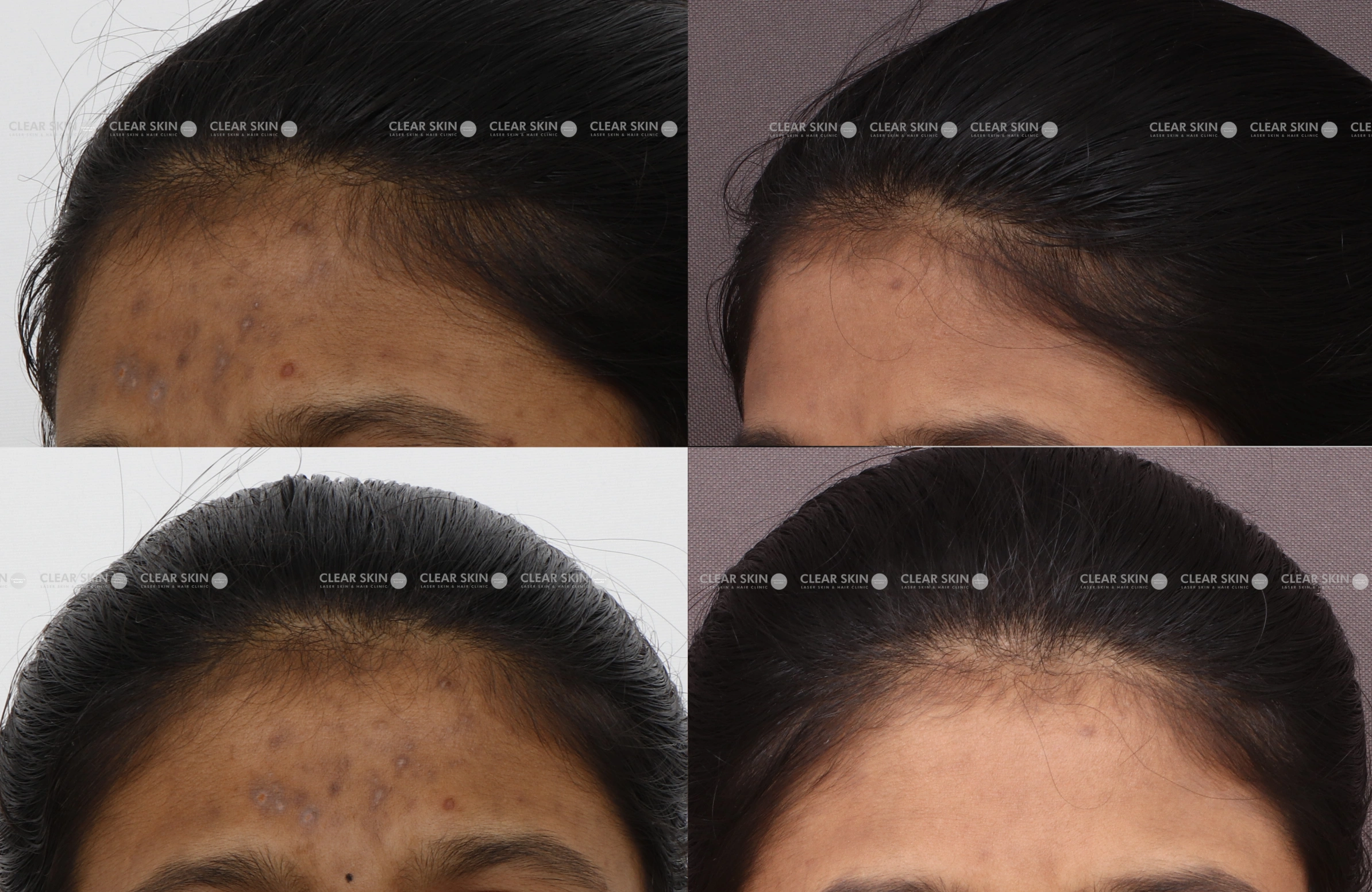 Pigmentation Results 4 Months Timeline 3 Sessions Clear Skin Pune