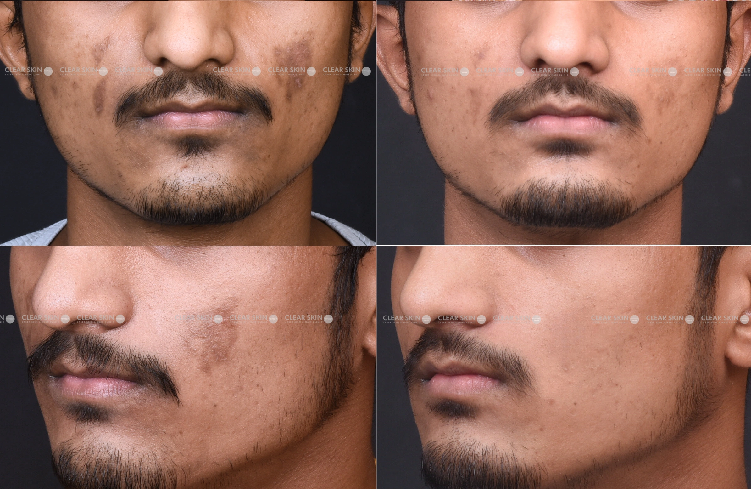 Pigmentation Results 5 Months Timeline 5 Sessions Clear Skin Pune