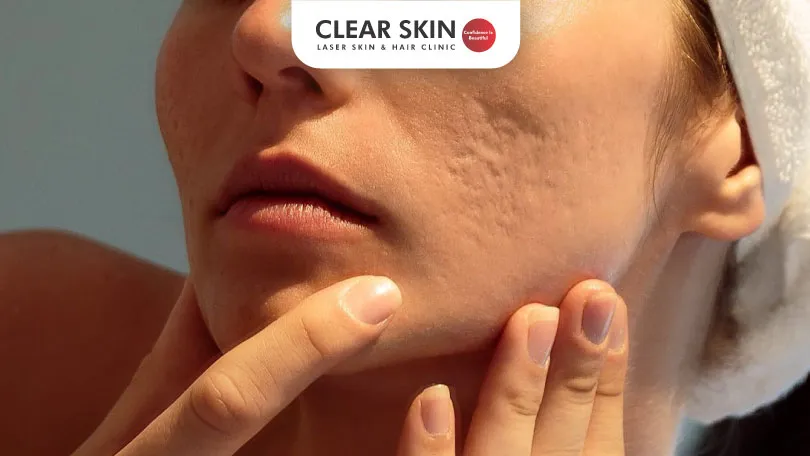 Pockmarks-Treatment-Get-a-Blemish-Free-Complexion-Clear-Skin-Pune Pockmarks Treatment Get a Blemish Free Complexion Clear Skin Pune