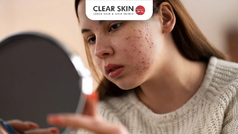 Scientific-Acne-Treatments-and-Myths scientific acne treatment and myths