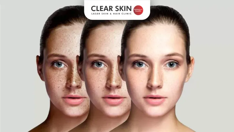 Skin Pigmentation Success Stories at Clearskin Skin Pigmentation Success Stories at Clearskin