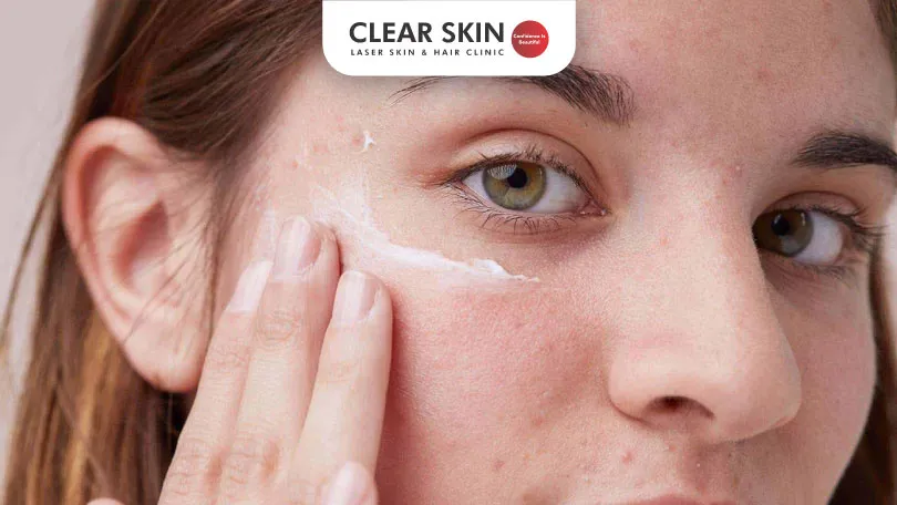 Sunscreens-That-Help-with-Melasma-Management-Clear-Skin-Pune Sunscreens That Help with Melasma Management Clear Skin Pune