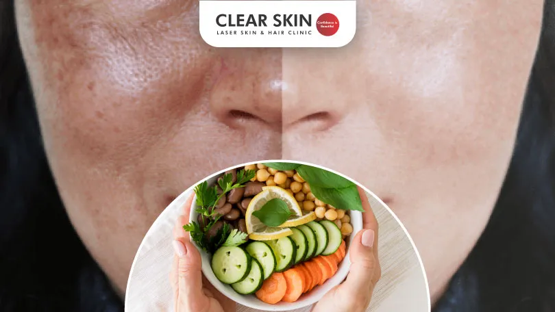 The-Link-Between-Diet-and-Melasma-Treatment-Clear-Skin-Pune (1) Link Between Diet and Melasma Treatment