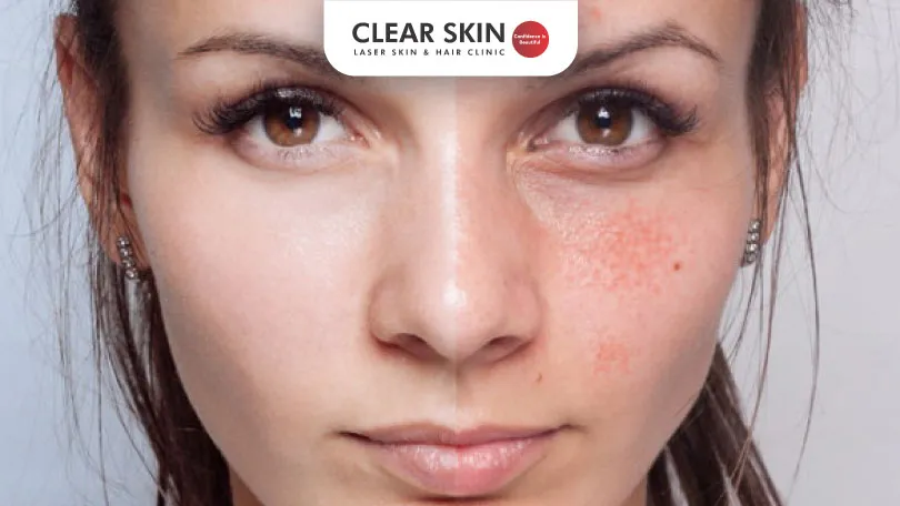 The-Pros-and-Cons-of-Spot-Peel-Treatment-for-Melasma-clear-skin-pune The Pros and Cons of Spot Peel Treatment for Melasma clear skin pune