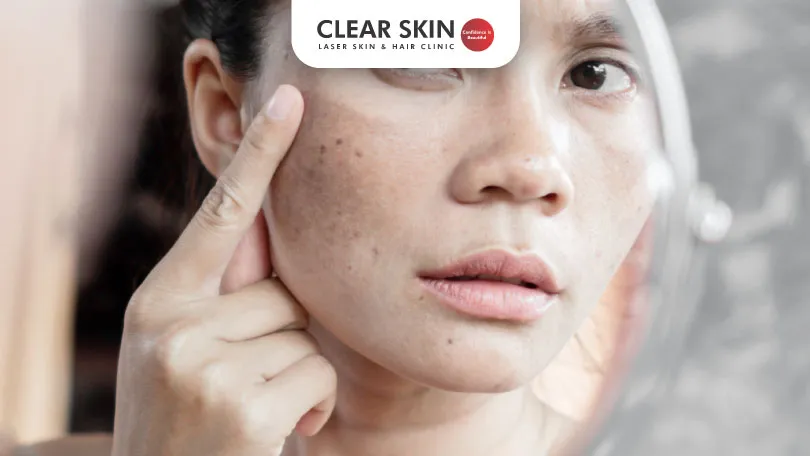 The-Top-FDA-Approved-Melasma-Treatments-for-Safe-and-Effective-Skin-Discoloration-Care-clear-skin-pune The Top FDA Approved Melasma Treatments for Safe and Effective Skin Discoloration Care clear skin pune