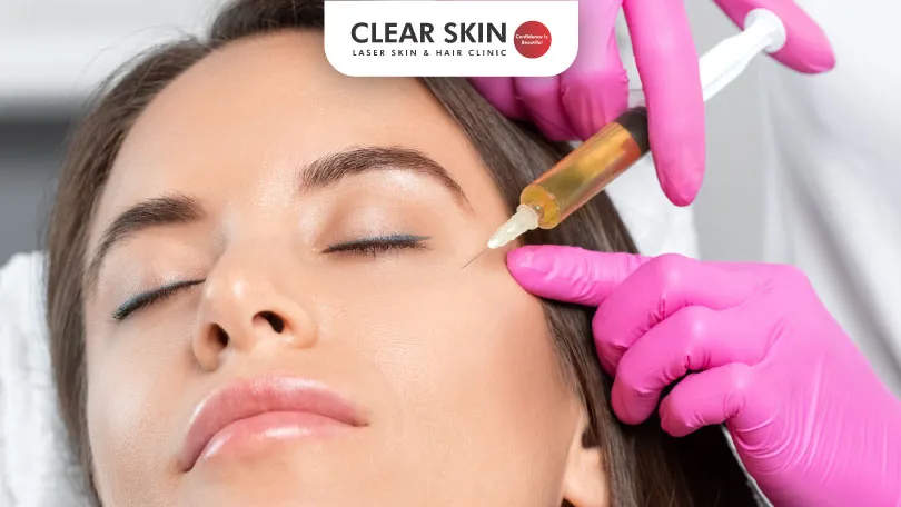 Benefits of PRP Therapy for Melasma Benefits of PRP Therapy for Melasma