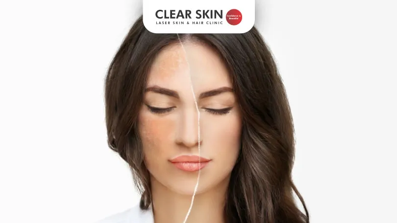 Unlocking-the-Mystery-of-Mandibular-Melasma-and-Centrofacial-Melasma-Causes,-Symptoms,-and-Treatment-Options-clear-skin-pune Unlocking-the-Mystery-of-Mandibular-Melasma-and-Centrofacial-Melasma-Causes,-Symptoms,-and-Treatment-Options-clear-skin-pune