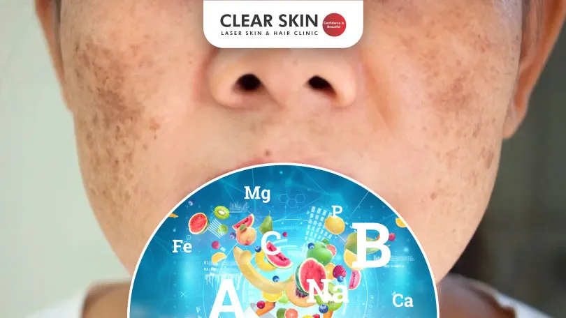 Unlocking the Secrets of Vitamins for Melasma Relief Clear Skin Pune