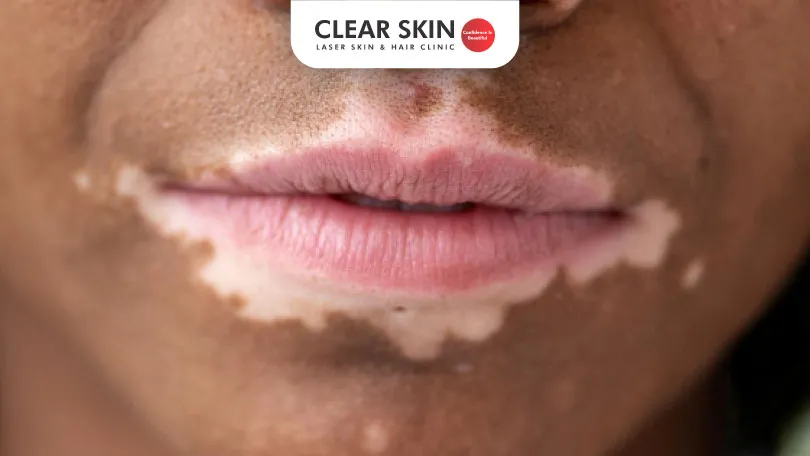 Vitiligo-on-lips Vitiligo on lips