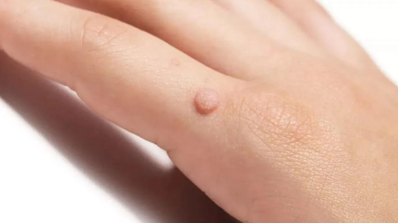 Warts Warts