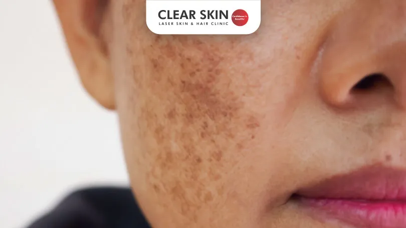 What-Does-Dermal-Melasma-Look-Like-Clear-Skin-Pune What Does Dermal Melasma Look Like Clear Skin Pune