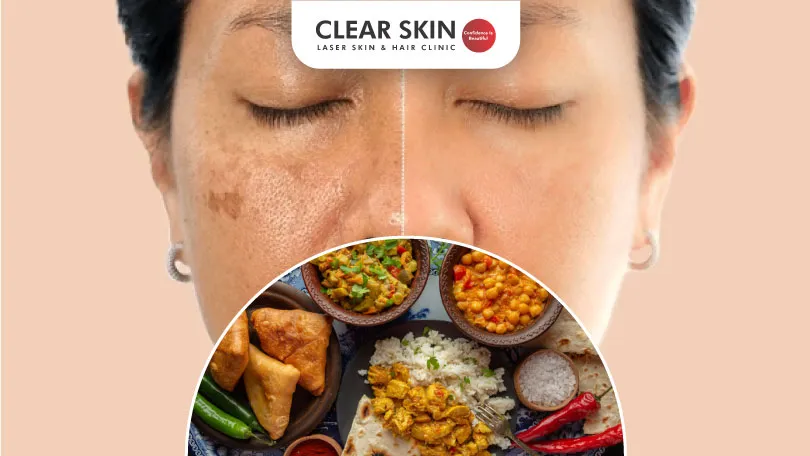 What Foods Cause Melasma Clear Skin Pune