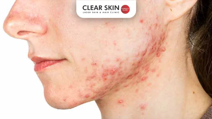 Severe Acne: Causes And Treatment Severe Acne: Causes And Treatment