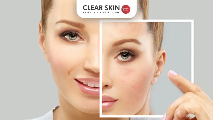 What-are-the-Oral-Treatments-for-Melasma-Clear-Skin-Pune oral treatment for melasma